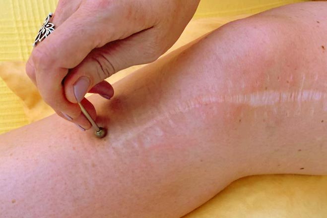 Susanne Chappuis-Zingg – Narbenbehandlung mit Shōnishin